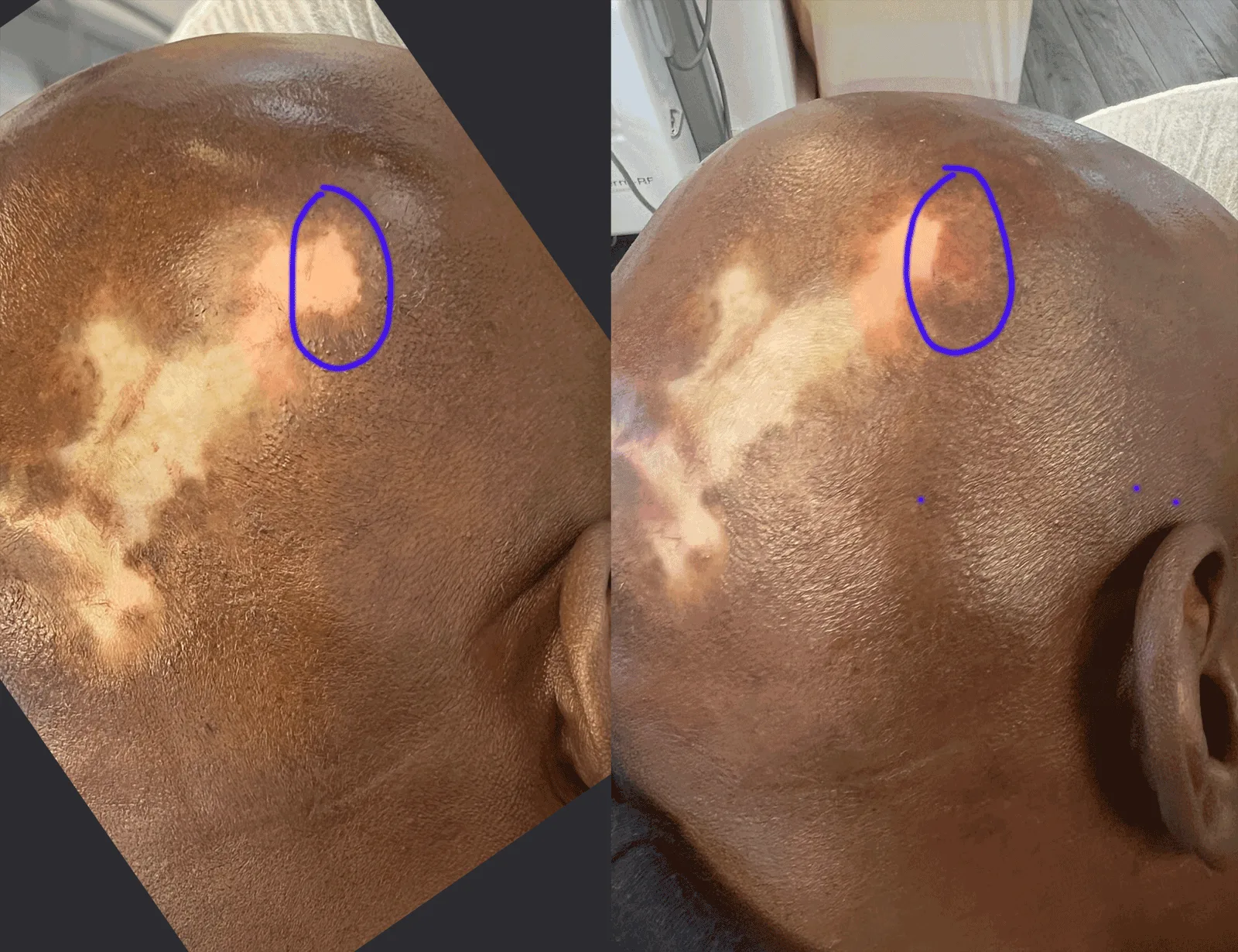 How do Vitiligo Tattoos Differ from Regular Tattoos